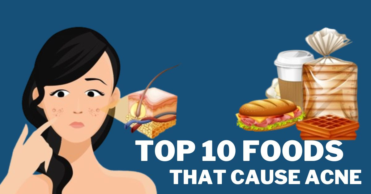 What Foods Cause Acne? A Deep Dive into Diet and Skin Health